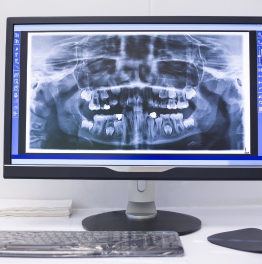Digital dental x rays on a computer screen