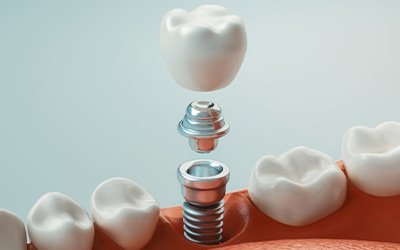 Digital image of a dental implant post, abutment, and crown
