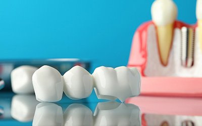 Sample dental bridge and implant on reflective surface with light blue background