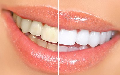 Before and after teeth whitening
