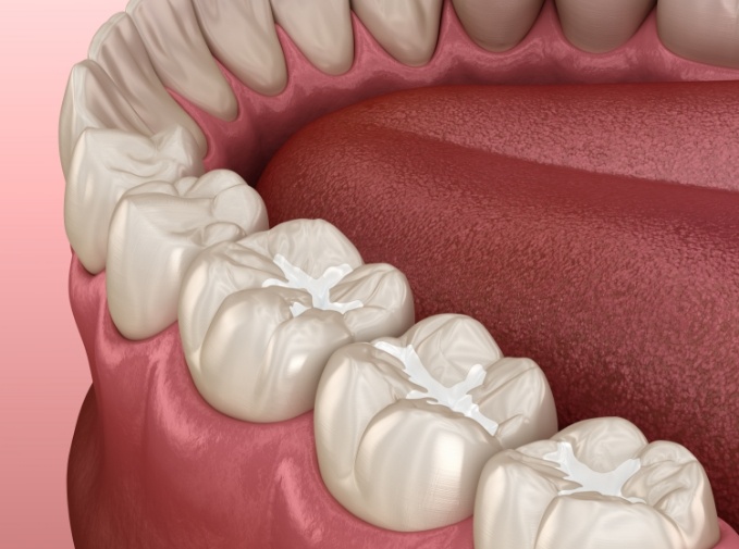 Animated row of teeth with dental sealants