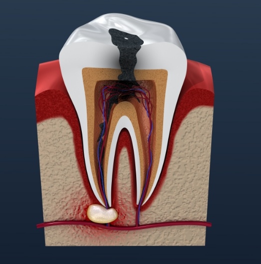 Animated tooth with infection inside the pulp and root