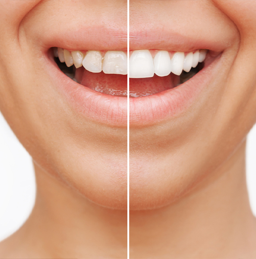 Close up of smile split down the middle showing before and after veneers