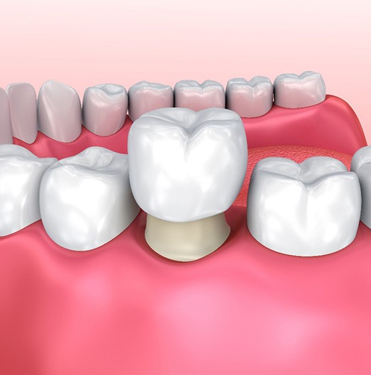 Dental crown in Northbrook