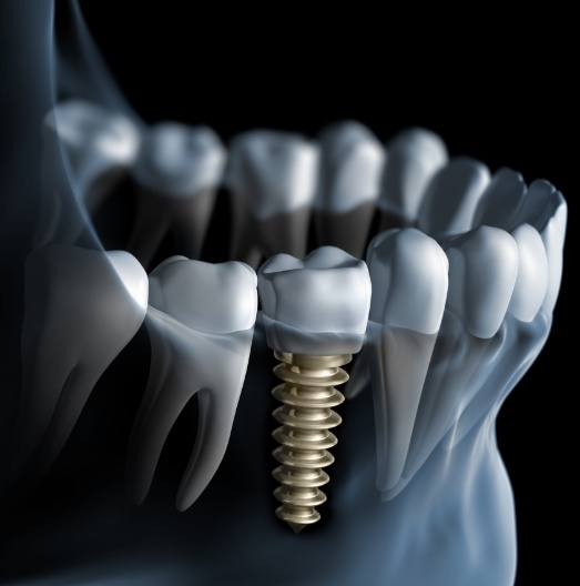 Animated x ray of a person with a dental implant