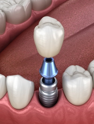 Animated dental implant with dental crown