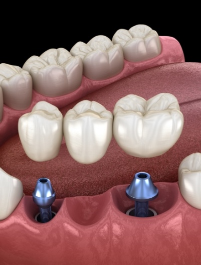 Animated dental bridge supported by two dental implants