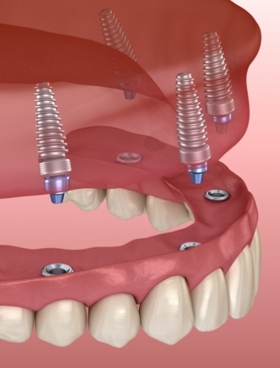 Animated implant denture supported by four dental implants