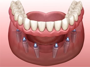 3D render of implant dentures