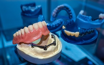Example of implant dentures in Northbrook
