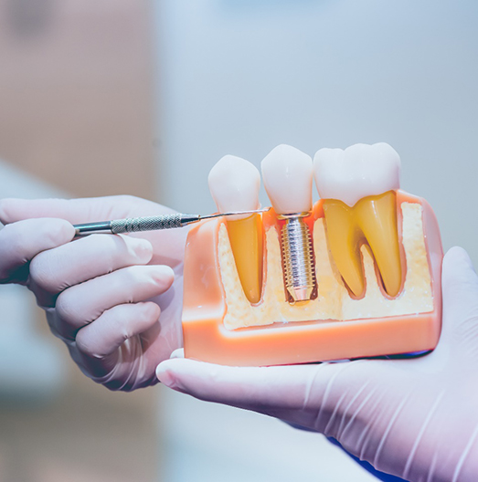 A dentist holding a dental implant mockup