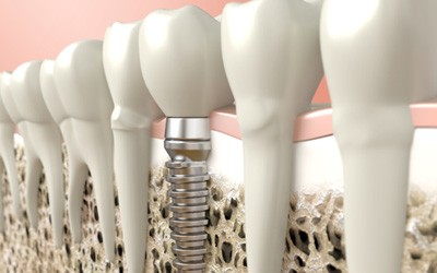 Digital illustration of a dental implant