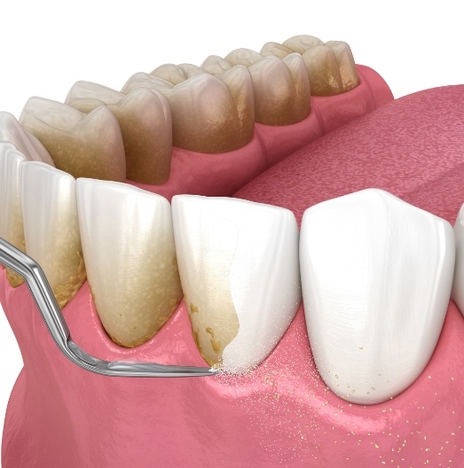 Animated dental tool removing plaque from teeth