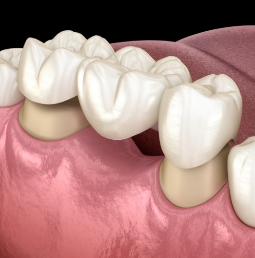 Animated dental bridge replacing a missing tooth