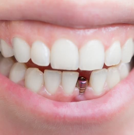 Close up of a smile with a visible dental implant abutment
