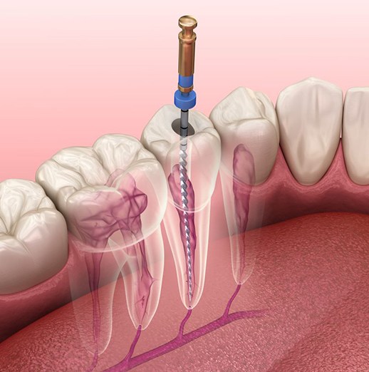 Illustration of instrument performing root canal treatment