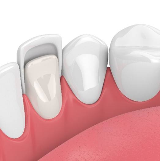 Illustration of veneer being placed on lower, front tooth