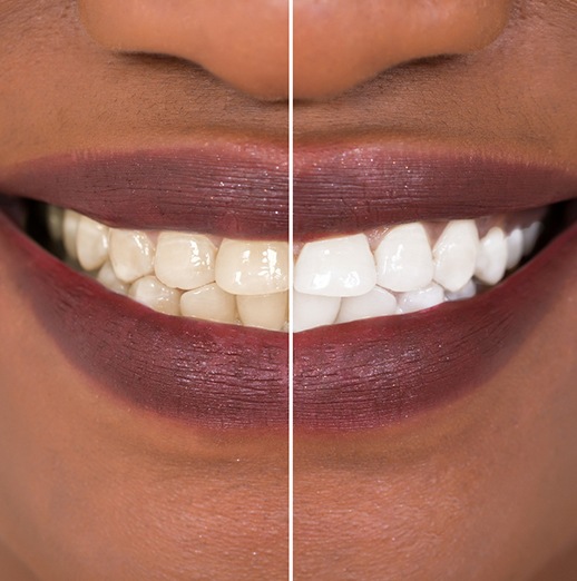 Patient's smile before and after teeth whitening