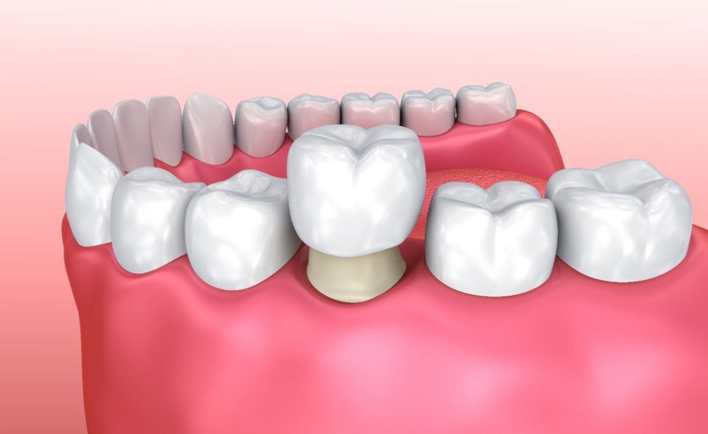 3D model of dental crown